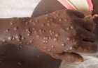 MPOX : l'épidémie prend de l'ampleur à Kinshasa, déjà 2 morts enregistrés 