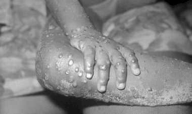 Le Monkeypox déclarée une urgence de santé publique de portée internationale (OMS)
