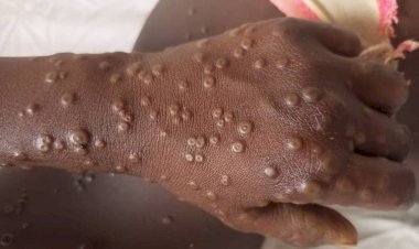 MPOX : l'épidémie prend de l'ampleur à Kinshasa, déjà 2 morts enregistrés 