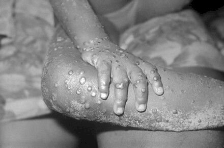 Le Monkeypox déclarée une urgence de santé publique de portée internationale (OMS)