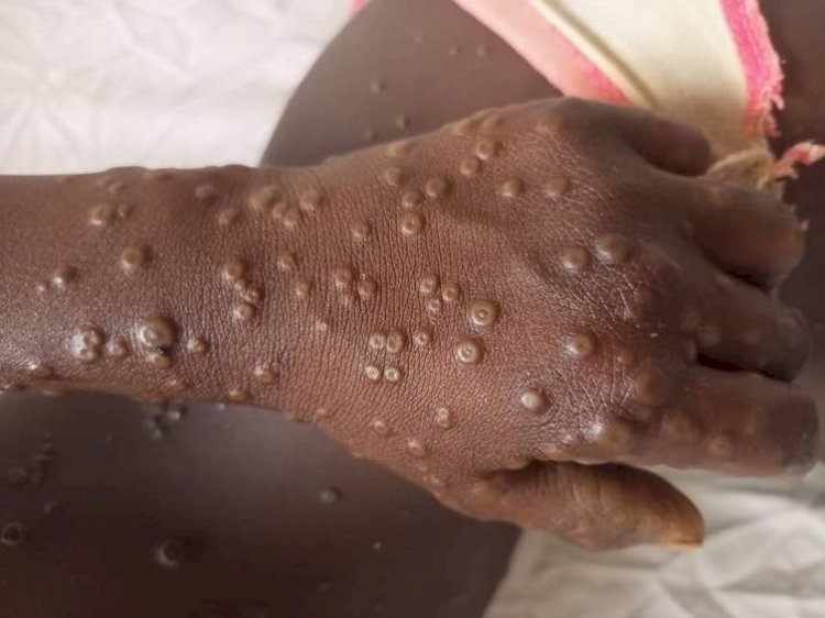 MPOX : l'épidémie prend de l'ampleur à Kinshasa, déjà 2 morts enregistrés
